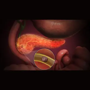 Acute Pancreatitis