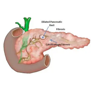 Chronic Pancreatitis