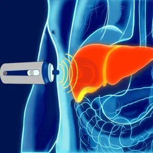 FibroScan
