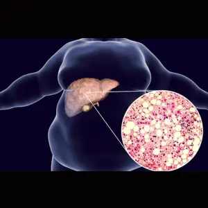 Fatty Liver Disease