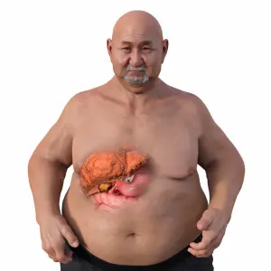 Non-Alcoholic Steatohepatitis (NASH)