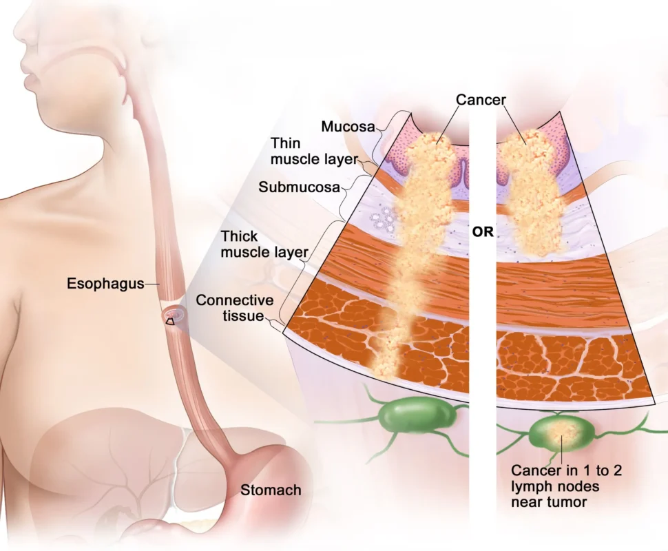 Esophageal Cancer Treatment