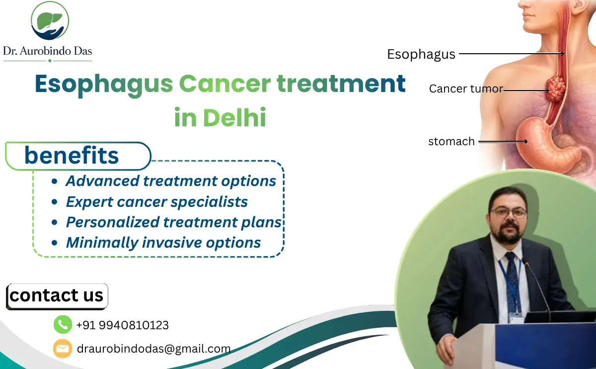 Esophagus Cancer treatment in Delhi