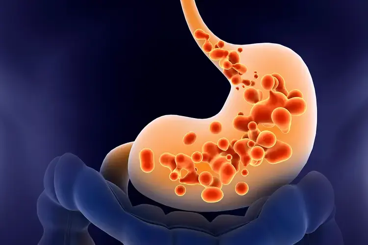 GERD( Acid Reflux )