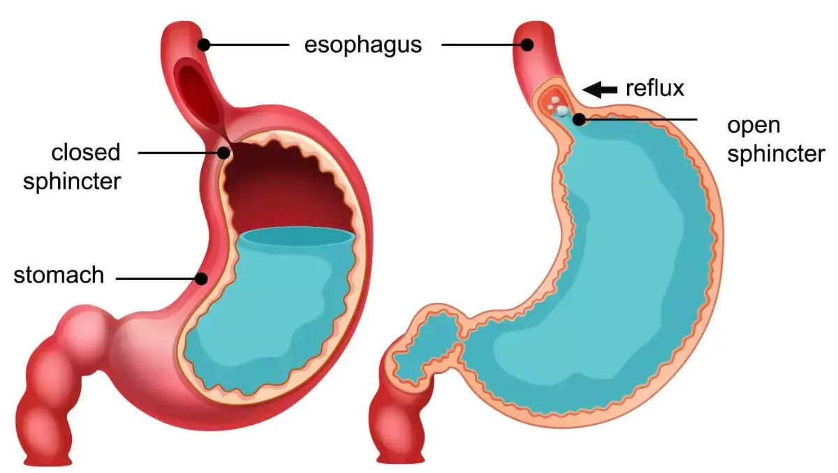 GERD (Acid Reflux) Treatment