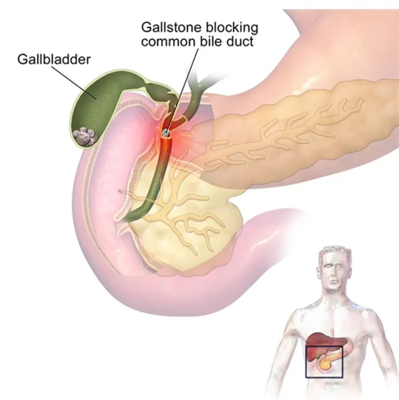 Gallbladder Stones Treatment