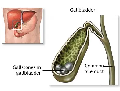 Gallbladder Stones
