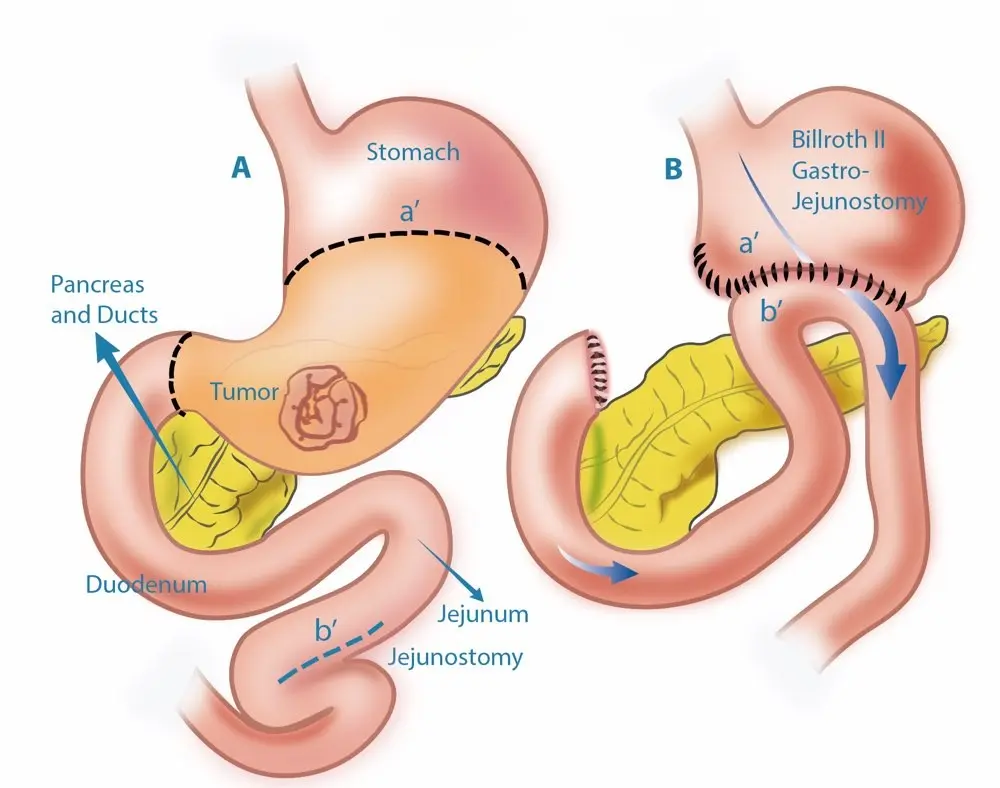 Gastric Cancer Treatment