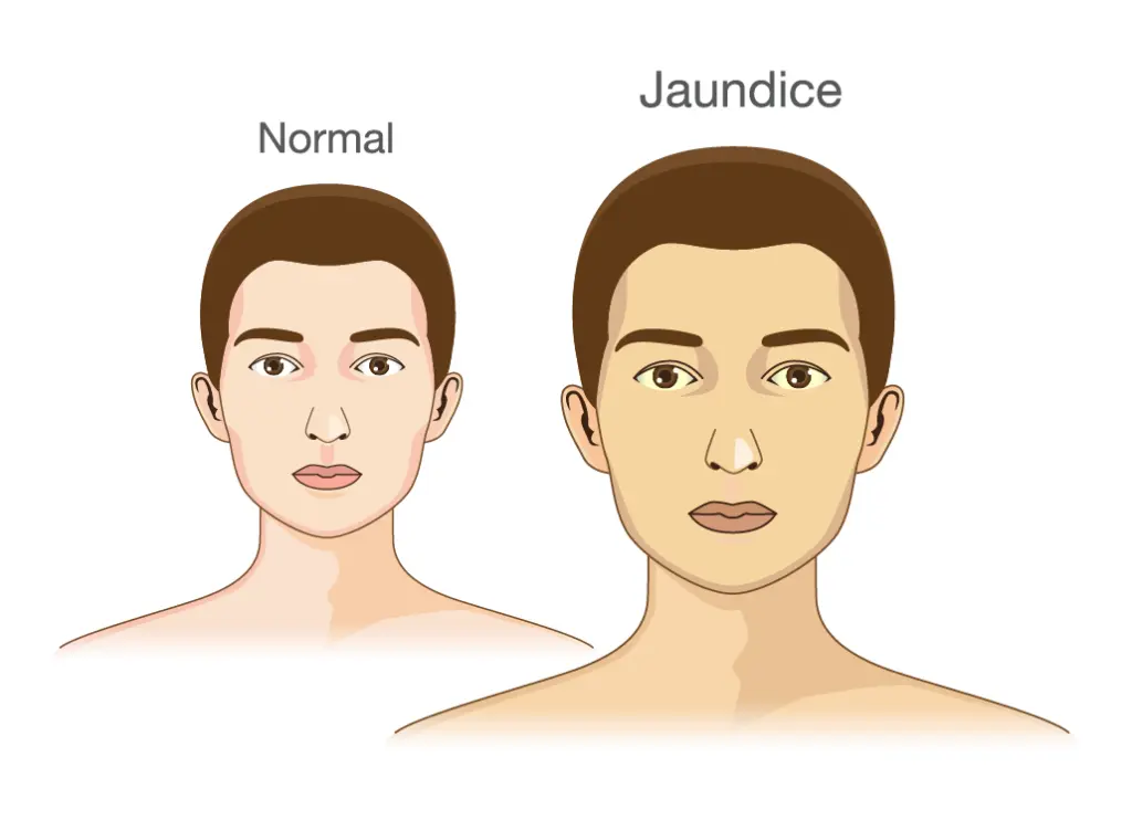 Jaundice Treatment
