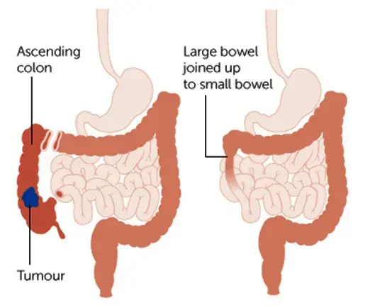 Small Bowl Tumor Treatment