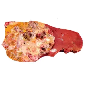 Hepatoblastoma Hepatoblastoma