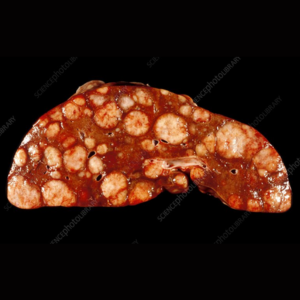 Secondary (Metastatic) Liver Cancer Secondary (Metastatic) Liver Cancer