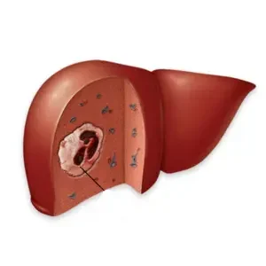 Hepatocellular Carcinoma (HCC) Hepatocellular Carcinoma (HCC)