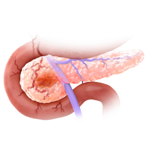 Pancreatic Ductal Adenocarcinoma (PDAC) Pancreatic Ductal Adenocarcinoma (PDAC)